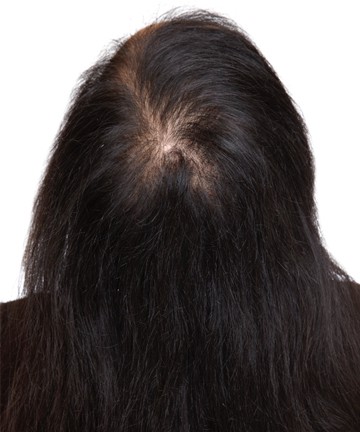Hair Loss Due to Eczema - Hair Growth Studio