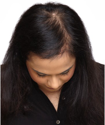 Hair Loss Due to Eczema - Hair Growth Studio