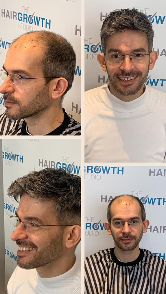 Hair Systems Manchester - Hair Loss Clinic - Non Surgical Hair Replacement