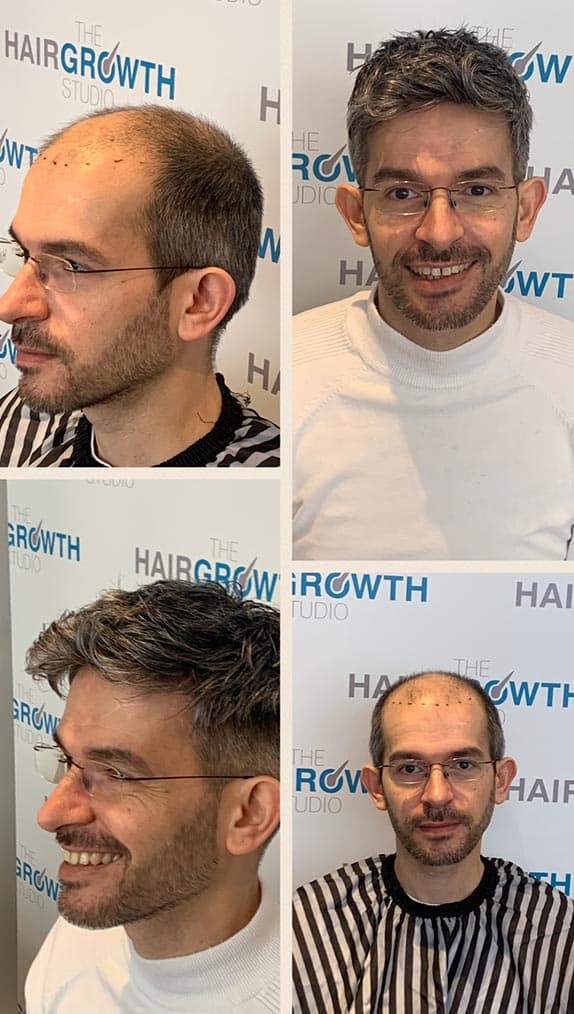 Hair Systems Manchester Hair Loss Clinic Non Surgical Hair Replacement